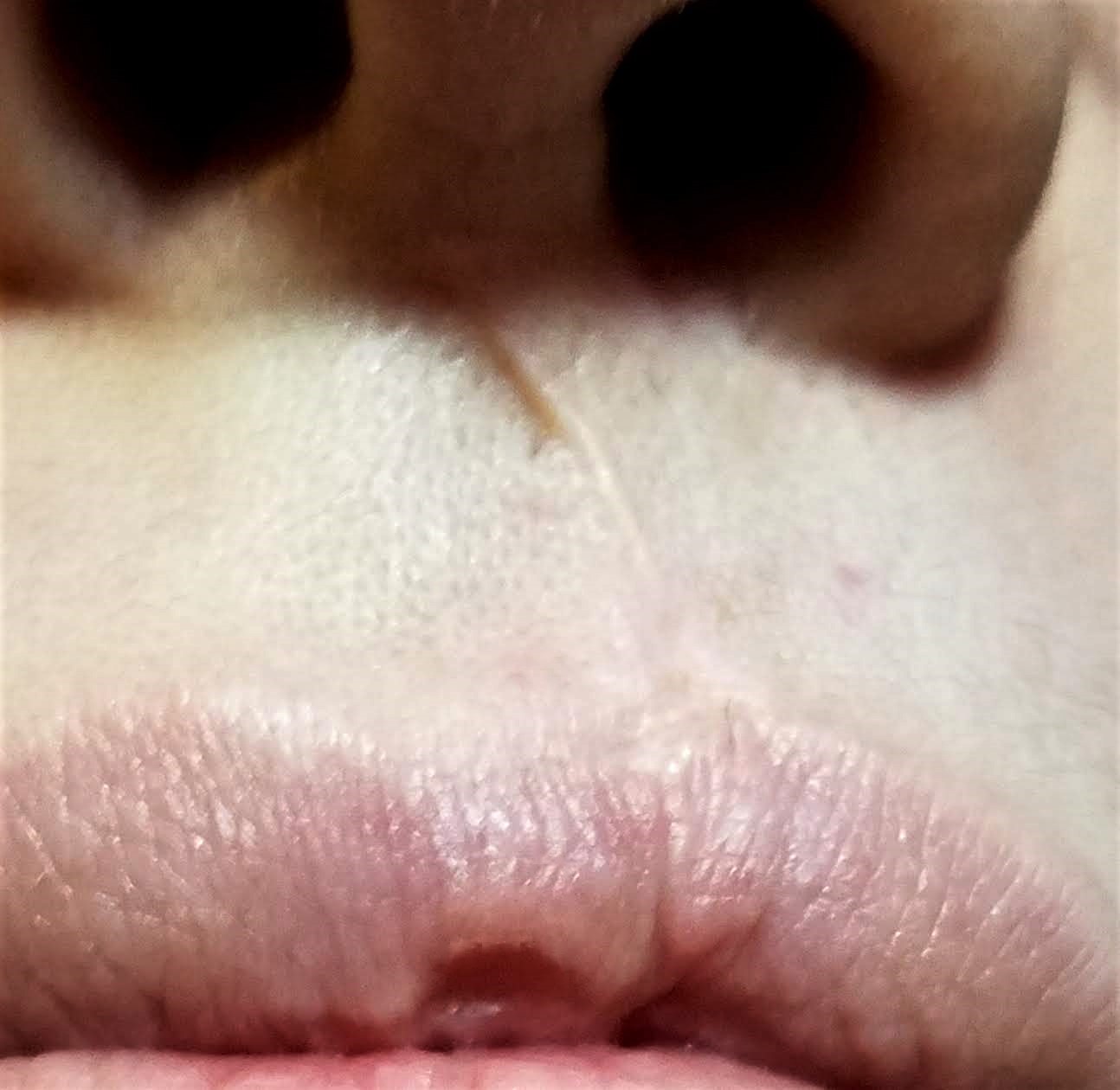 cleft lip scar