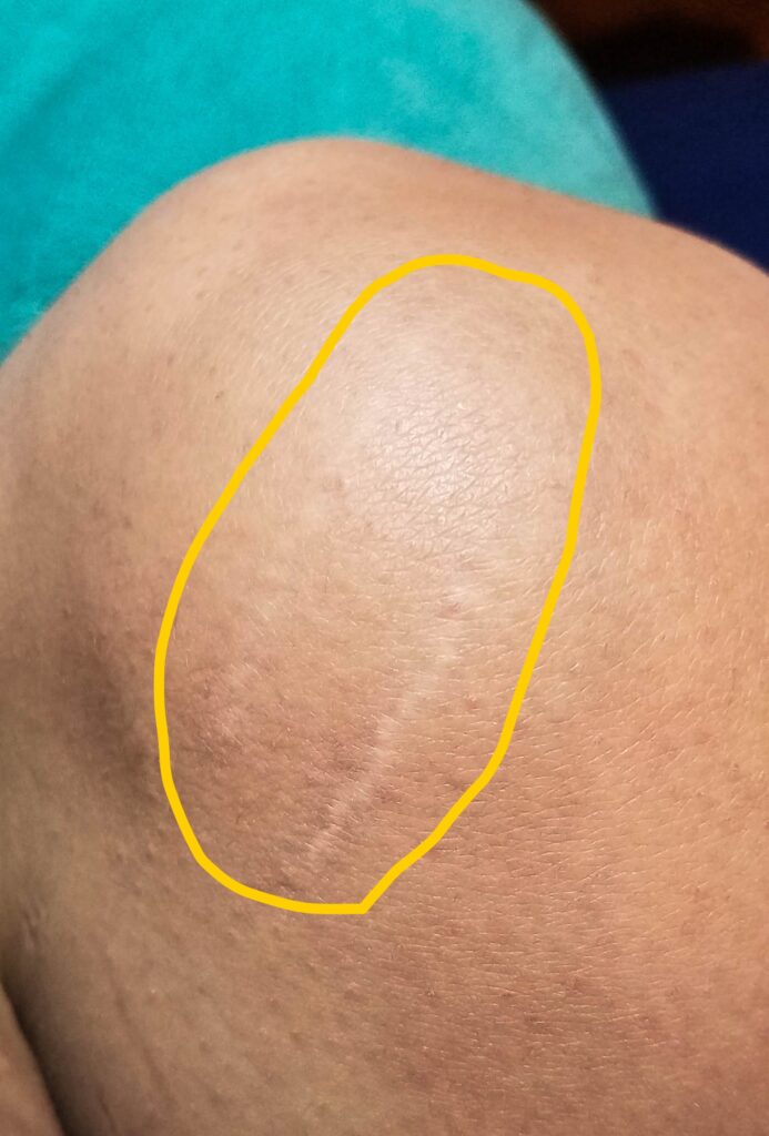 Stretch marks on knee